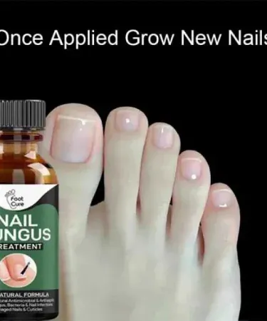Nail Fungus Treatment Stop Fungal Growth Effective Fingernail 10ml bottle – antifungal solution for nails