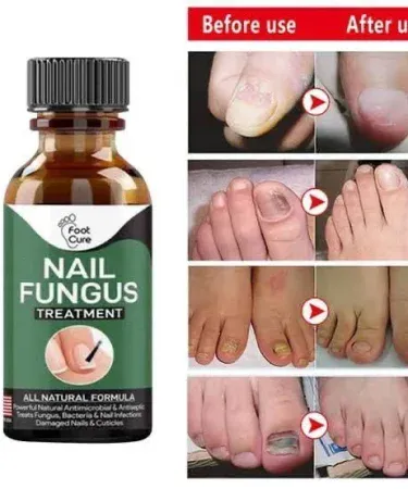 Nail Fungus Treatment Stop Fungal Growth Effective Fingernail 10ml bottle – antifungal solution for nails