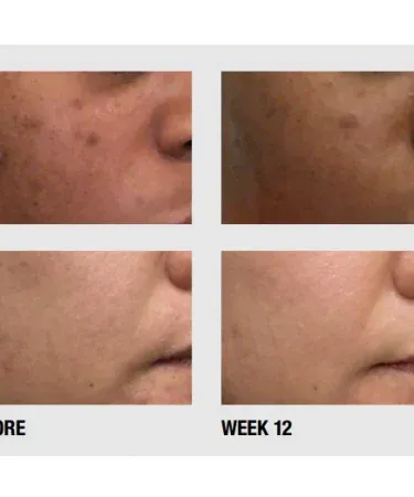 ADAPCO Gel (Adapalene 0.1% USP) 15 g acne treatment tube on white background, imagecaption=ADAPCO Gel – Dermatologist‑recommended acne gel available on Khareedo & Kharedo with Check on Delivery.