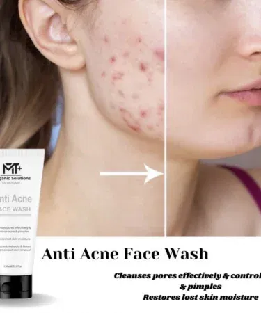 Acne Face Wash for Oily Skin – Medicated Deep Cleansing Face Wash for Men and Women